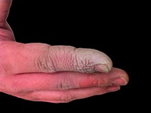 chemical burn on hand