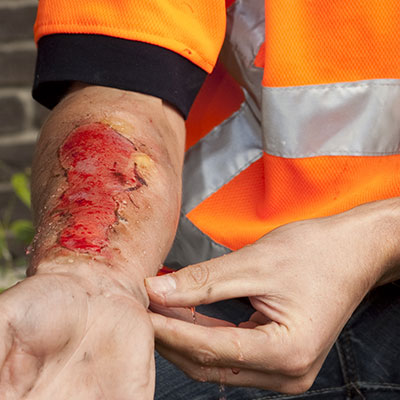 Safety worker wearing an orange and silver safety shirt pointing at a burn on the inside of his forearm